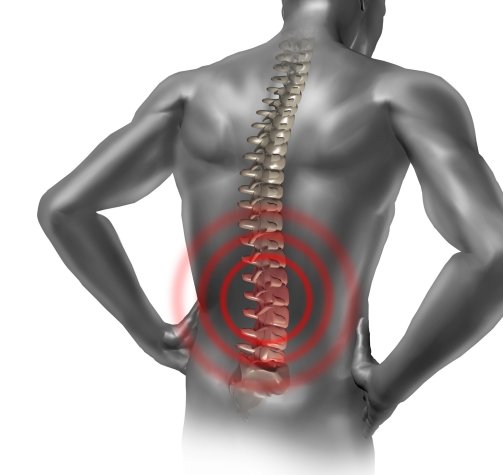 Mi okozza leggyakrabban az isiászt?